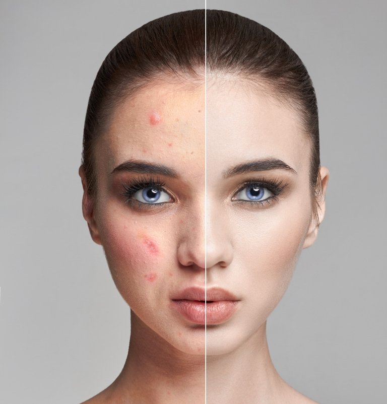 acne scar treatment in kakinada