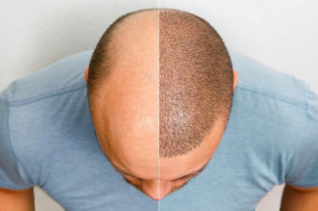 Scalp Micro Pigmentation Treatment in Kakinada