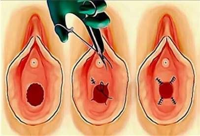 hymenoplasty surgery in kakinada