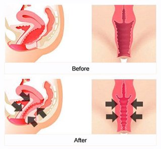 Vaginoplasty in Kakinada