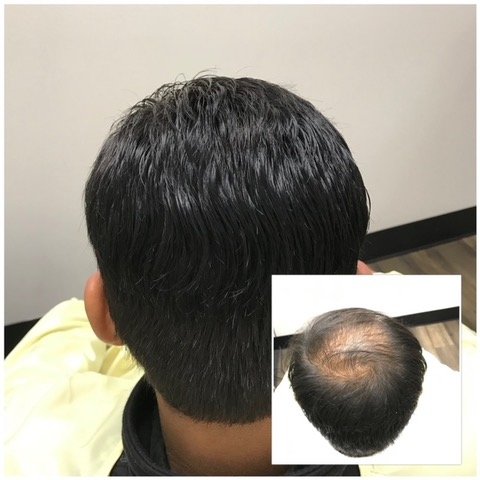 Non Surgical Hair Replacement in Kakinada