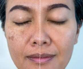Pigmentation