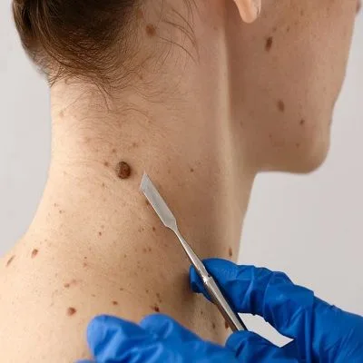 Wart removal in Kakinada at Tricure Clinics using laser or radiofrequency for scar-free skin