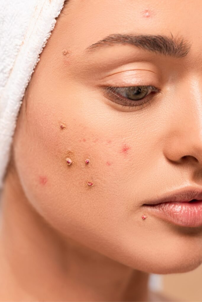 Acne & Pigmentation Treatment in Rajahmundry and Kakinada