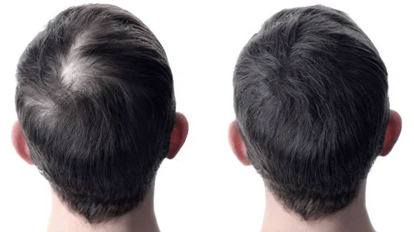 best hair fall control treatment